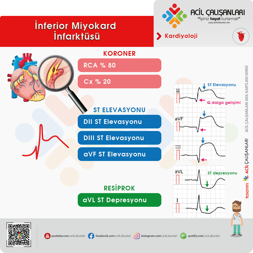 İnferior STEMI EKG görünümü