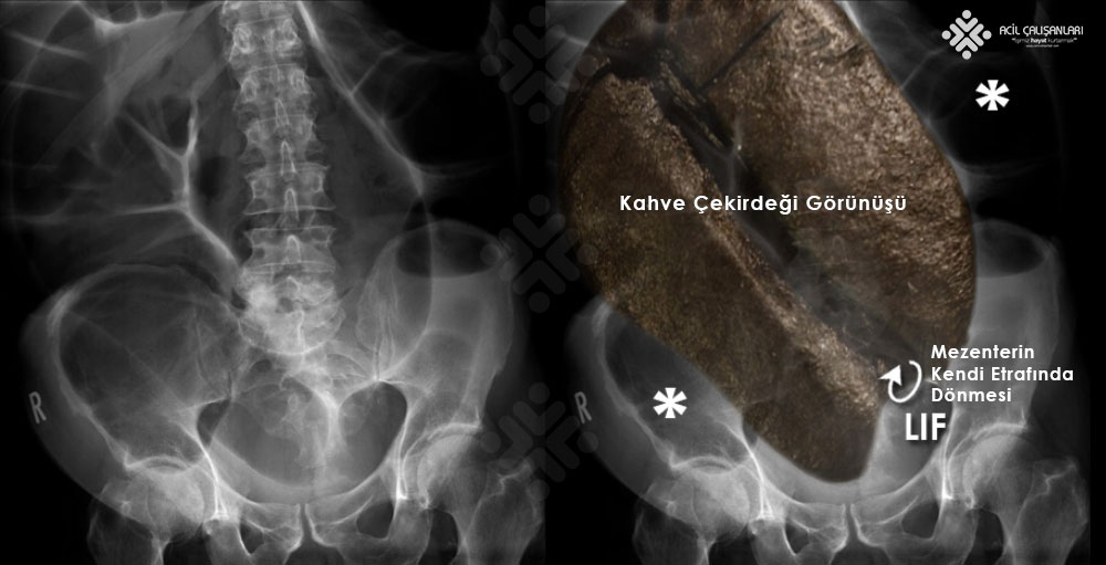 Sigmoid volvulus kahve çekirdeği görünümü