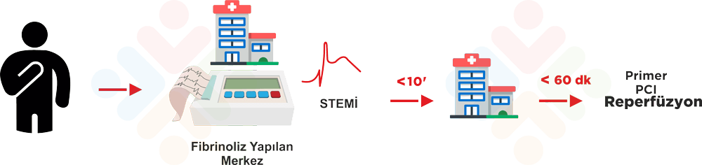 STEMI EKG örneği